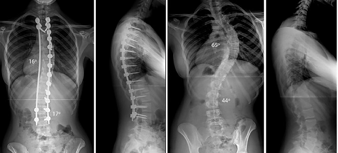 Рентгеновский снимок до и после операции по устранению сколиотической деформации позвоночника. Слева состояние после операции, с право перед хирургическим вмешательством.
