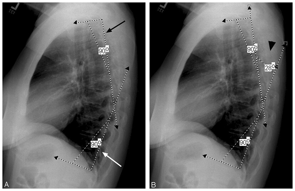 Кифоз грудного отдела позвоночника на рентгеновском снимке